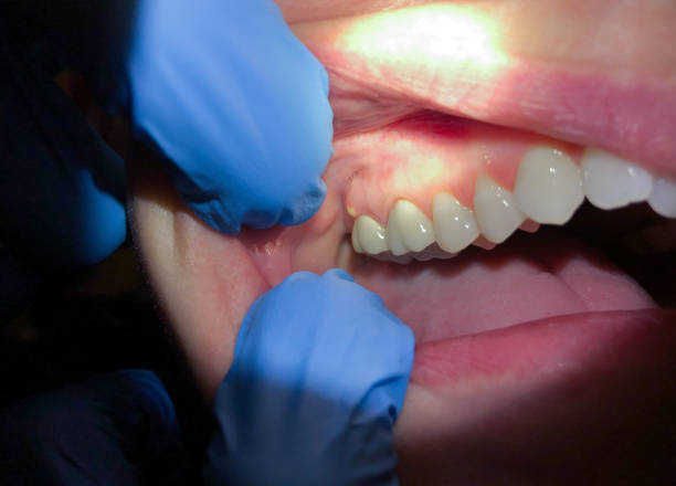 Best Emergency Wisdom Teeth Removal in Clifton, NJ